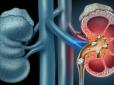 Ви могли це не знати! ТОП-5 продуктів, через які утворюються камені в нирках
