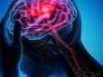 Не пропустіть! Що провокує інсульт  та які перші ознаки